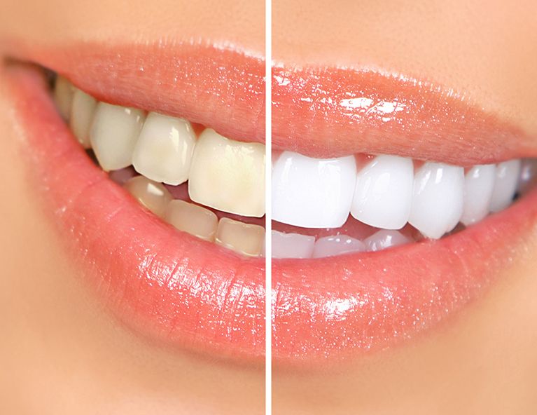 Teeth Whitening
